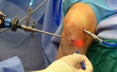 Arthroscopic Injury Treatment