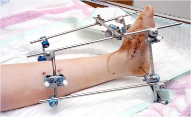 Fracture Surgery