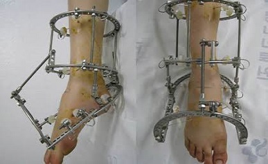 Ilizarov Surgery