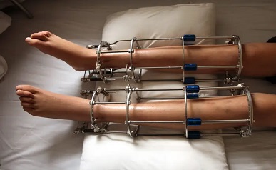 Limb Lengthening Surgery